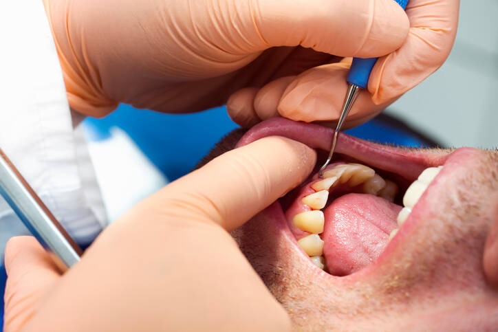 Periodontal sykdom: hvorfor oppstår det + Hvordan stoppe tennene fra å vakle og gjøre dem sterkere?