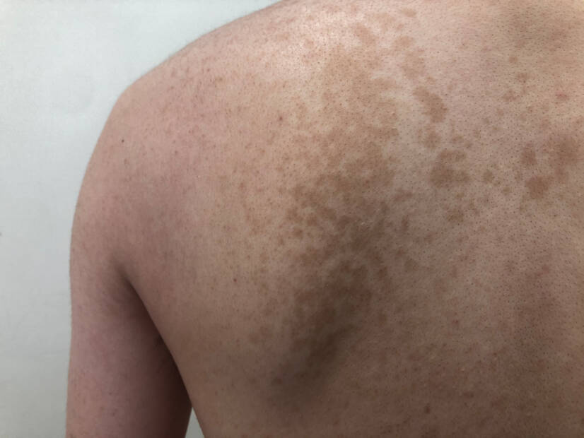 Pityriasis versicolor: Hva er det og hvilke symptomer har det? Årsaker og smittsomhet