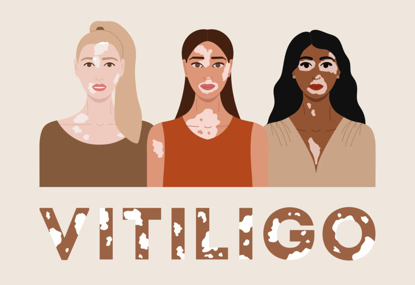 Vitiligo: Hva er vitiligo, hva er årsakene og symptomene, og når oppstår det?