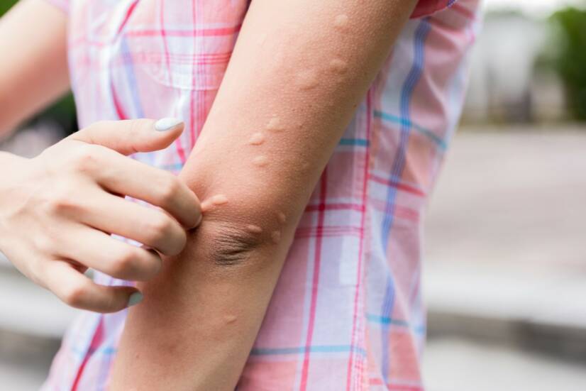 Urticaria: Urticaria ikke bare etter brennesle? Betyr det en sykdom?