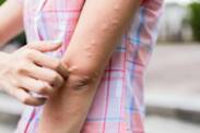 Urticaria: Urticaria ikke bare etter brennesle? Betyr det en sykdom?